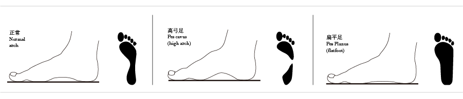 腳形的選擇